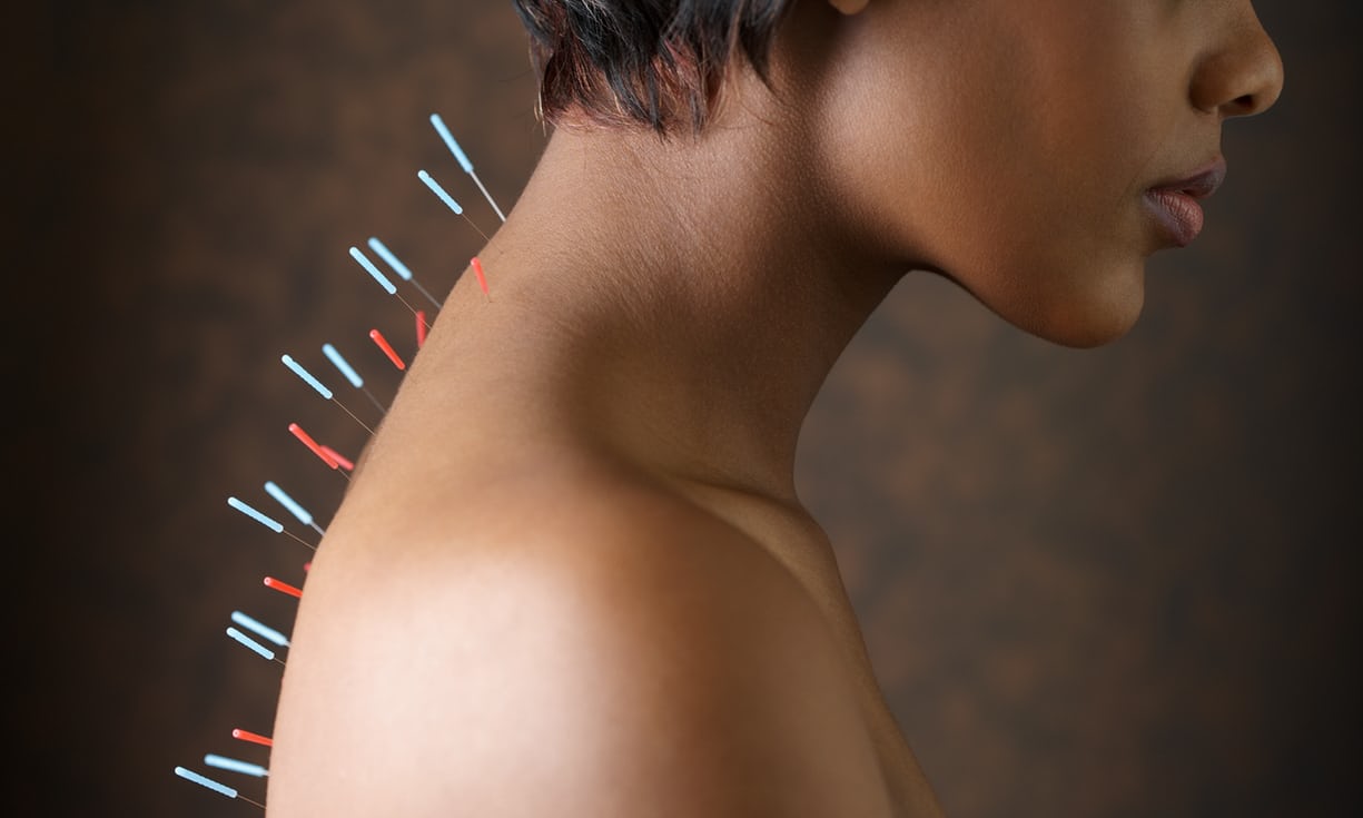acupunctuur bij nek en mobilteitis klachten